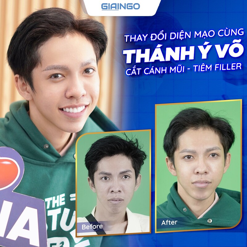 Wo Thanh Yi phẫu thuật thẩm mỹ